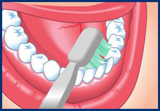 Nettoyez chaque surface de chaque dent : le dessus, le ct de la joue et celui de la langue.