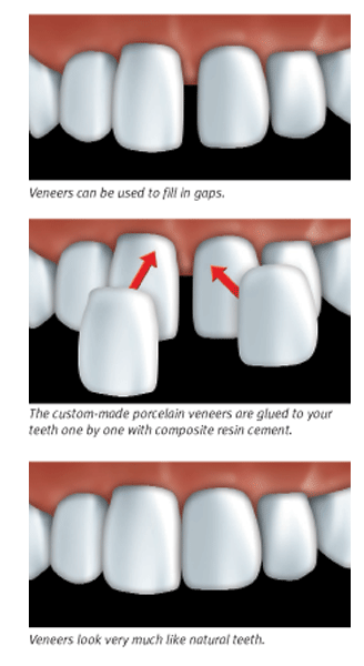 how are porcelain veneers placed on teeth