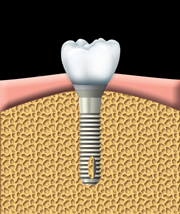 An artificial tooth is attached to the abutment. Properly fitting the artificial tooth may take several appointments