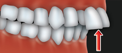 An overjet occurs when the upper front teeth protrude