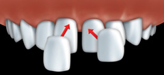 Fabriques sur mesure, les facettes en porcelaine sont colles  vos dents une  une  l'aide d'un ciment de rsine composite.
