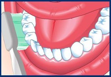 Brush at a 45 angle to your teeth. Put the bristles at the place where your gums and teeth meet. Use gentle circles. Don't scrub. Years of brushing too hard can make your gums recede