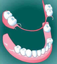 A partial denture (or removable partial denture)
