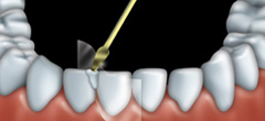A clear plastic is placed between the tooth being treated and its neighbouring tooth. Composite resin is put on the tooth in layers.