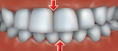 A crossbite occurs when one or more of your upper teeth don't line up with the appropriate lower tooth or teeth
