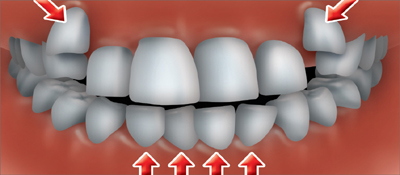 Crowded or Overlapped teeth