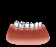 Dents temporaires réalistes 2 types Couronne dentaire résistante temporaire  avec différentes tailles Soins bucco-dentaires Couronne antérieure
