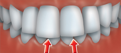 A deep bite occurs when the upper front teeth cover the lower front teeth too much.