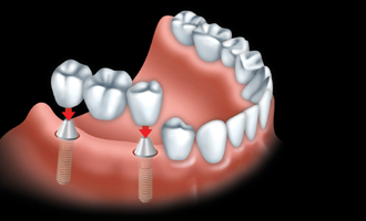 A fixed bridge is anchored to dental implants to replace all teeth