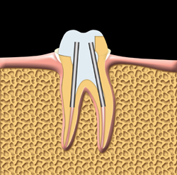 The tooth is prepared for a crown.  Posts are used to help support the crown.